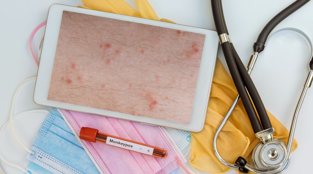 viruela del mono-monkey pox